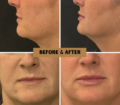 Dermal filler before and after comparison for full lip enhancement treatment in Peoria AZ
