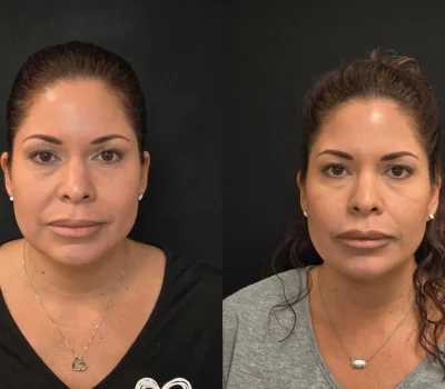 Lip augmentation before and after photos using hyaluronic acid dermal fillers in Peoria AZ