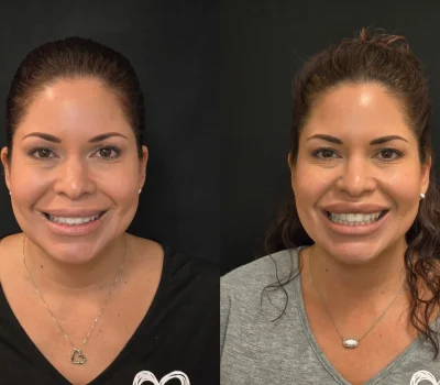 Before and after dermal filler injection results for lip enhancement in Peoria AZ