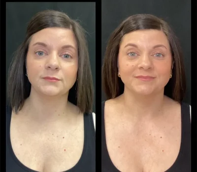 Before and after natural lip filler injection results in Peoria AZ