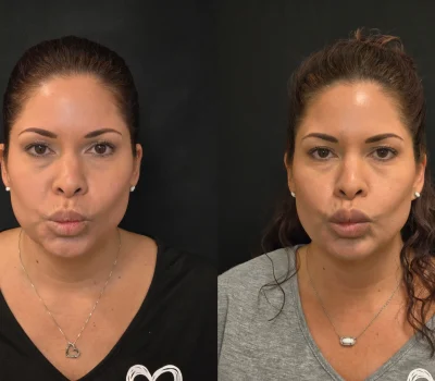 Before and after lip filler treatment showing enhanced volume and shape in Peoria AZ