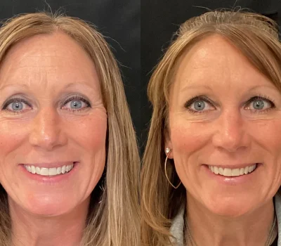 Before and after neuromodulator injections showing forehead wrinkle reduction in Peoria AZ