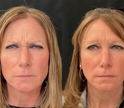 Forehead line smoothing results before and after neuromodulator injection treatment in Peoria AZ