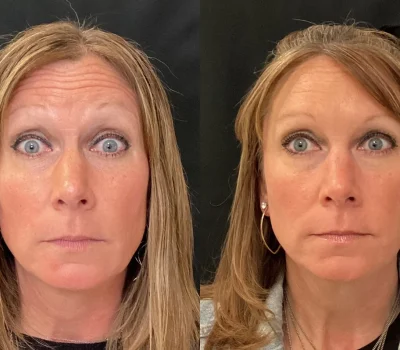 Before and after facial injection results for crow's feet and forehead wrinkles in Peoria AZ