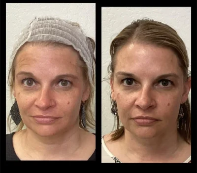 Female patient before and after neuromodulator treatment for smoothing forehead wrinkles in Peoria AZ
