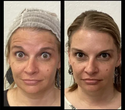 Before and after comparison of anti-wrinkle neuromodulator treatment on forehead lines in Peoria AZ