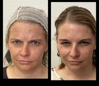 Before and after photos of female forehead wrinkle reduction using neuromodulator injections in Peoria AZ