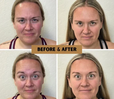 Before and after forehead line reduction using neuromodulator injections in Peoria AZ