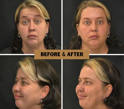 Before and after neuromodulator treatment for forehead lines and glabella wrinkles in Peoria AZ